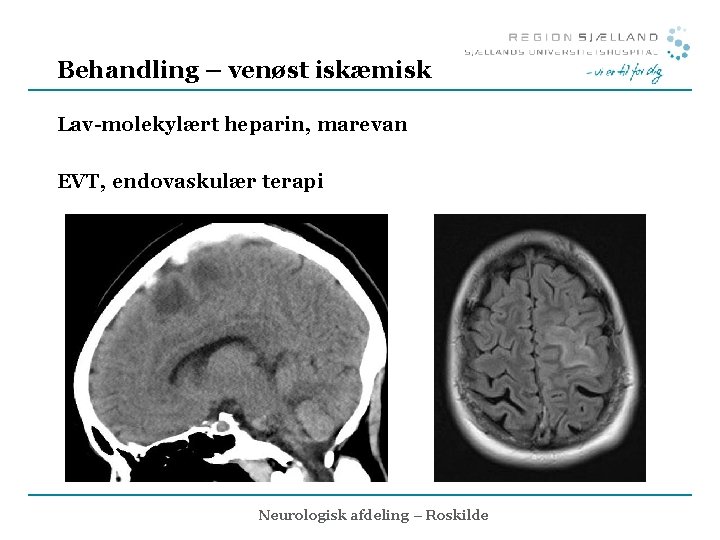 Behandling – venøst iskæmisk Lav-molekylært heparin, marevan EVT, endovaskulær terapi Neurologisk afdeling – Roskilde