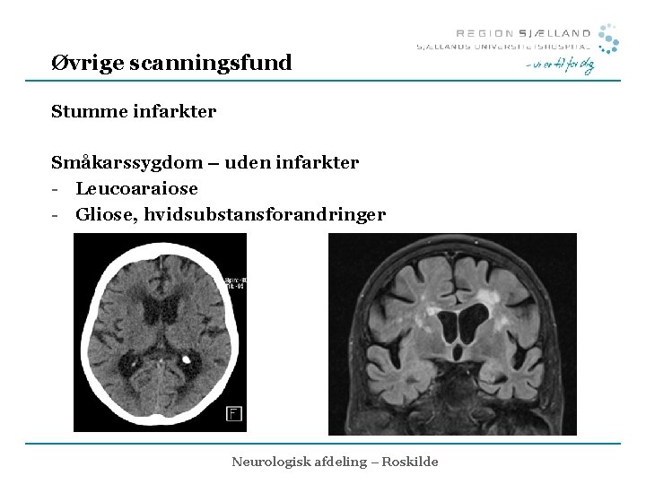 Øvrige scanningsfund Stumme infarkter Småkarssygdom – uden infarkter - Leucoaraiose - Gliose, hvidsubstansforandringer Neurologisk