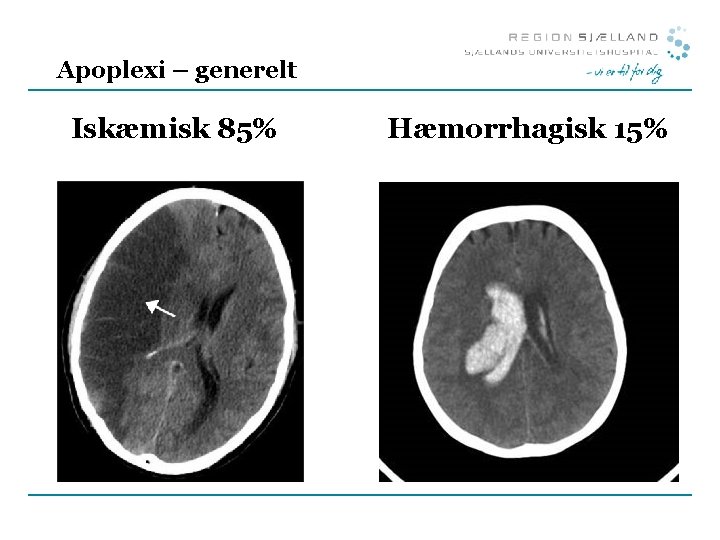 Apoplexi – generelt Iskæmisk 85% Hæmorrhagisk 15% 