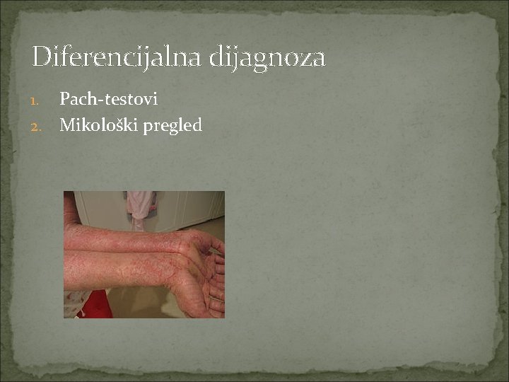 Diferencijalna dijagnoza Pach-testovi 2. Mikološki pregled 1. 