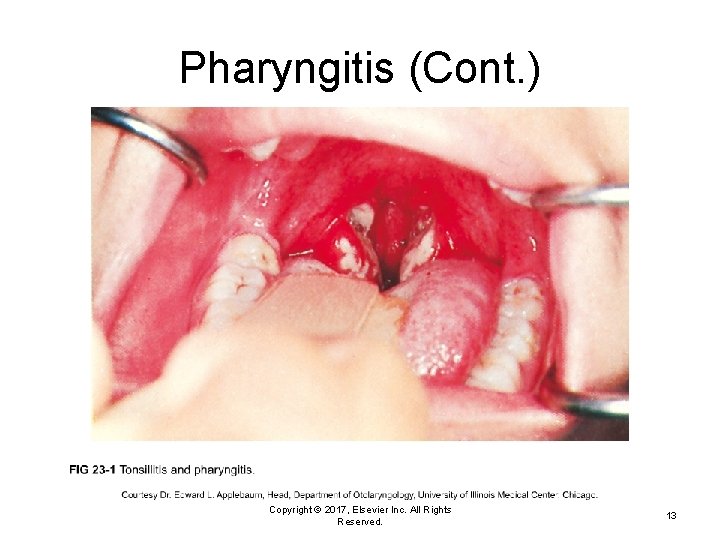 Pharyngitis (Cont. ) Copyright © 2017, Elsevier Inc. All Rights Reserved. 13 