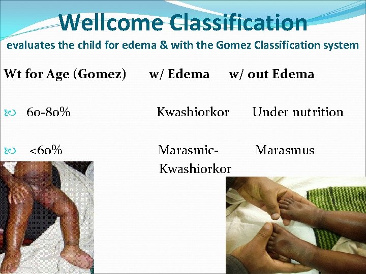 Wellcome Classification evaluates the child for edema & with the Gomez Classification system Wt