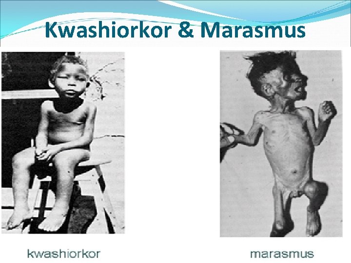 Kwashiorkor & Marasmus 