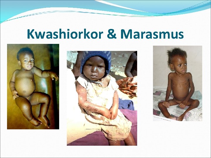 Kwashiorkor & Marasmus 