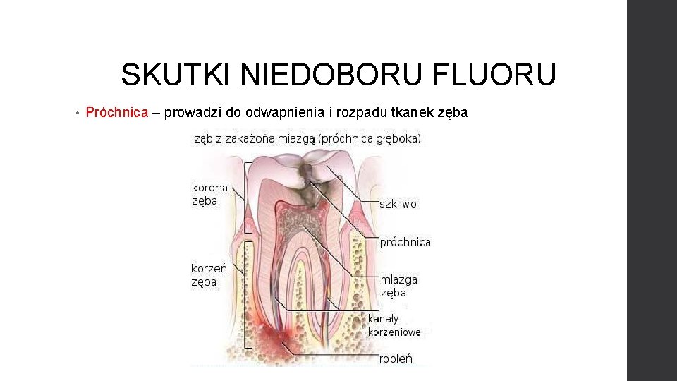 SKUTKI NIEDOBORU FLUORU • Próchnica – prowadzi do odwapnienia i rozpadu tkanek zęba 