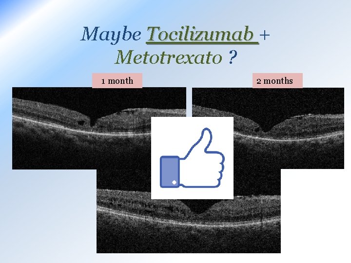 Maybe Tocilizumab + Metotrexato ? 1 month 2 months 6 months 