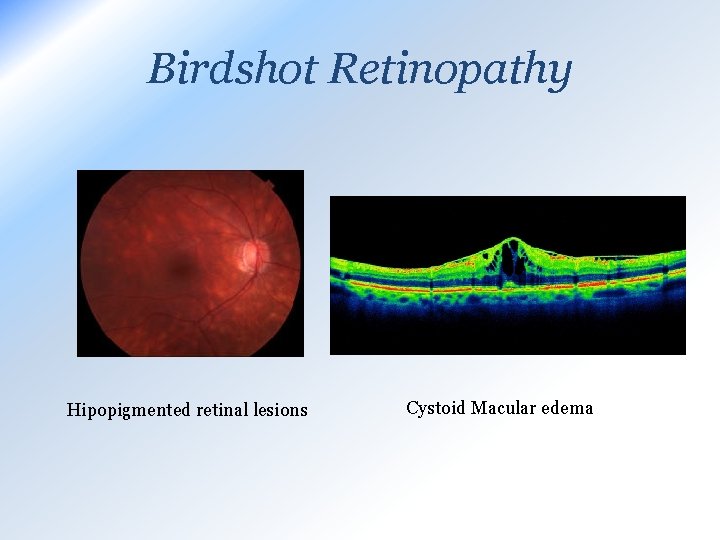 Birdshot Retinopathy Hipopigmented retinal lesions Cystoid Macular edema 