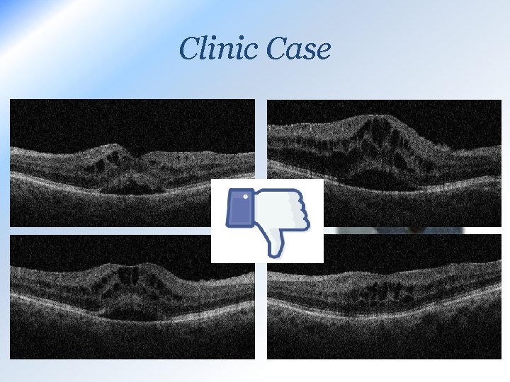 Clinic Case AVASTIN BOTH EYES 