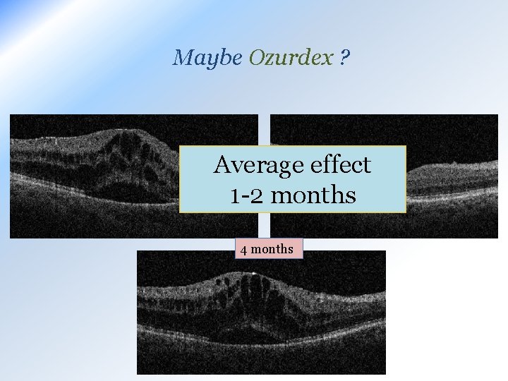 Maybe Ozurdex ? 1 month Average effect 1 -2 months 4 months 