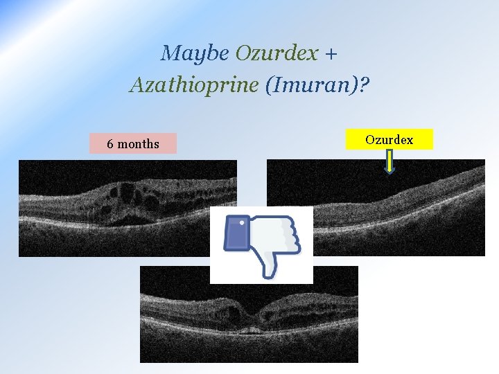 Maybe Ozurdex + Azathioprine (Imuran)? Ozurdex 6 months 11 months 