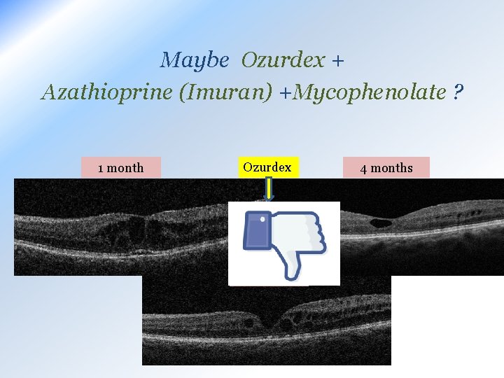 Maybe Ozurdex + Azathioprine (Imuran) +Mycophenolate ? 1 month Ozurdex 10 months 4 months