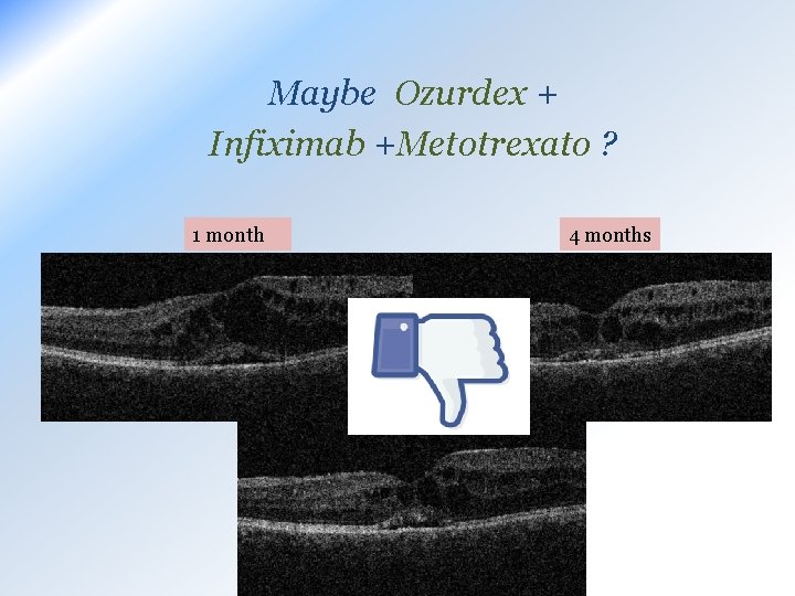 Maybe Ozurdex + Infiximab +Metotrexato ? 1 month 4 months 8 months 