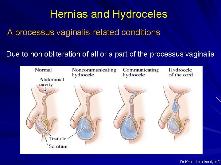Hernias and Hydroceles A processus vaginalis-related conditions Due to non obliteration of all or Hernias and Hydroceles A processus vaginalis-related conditions Due to non obliteration of all or