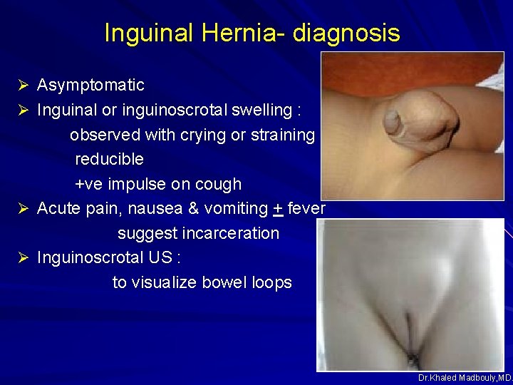 Inguinal Hernia- diagnosis Ø Asymptomatic Ø Inguinal or inguinoscrotal swelling : observed with crying Inguinal Hernia- diagnosis Ø Asymptomatic Ø Inguinal or inguinoscrotal swelling : observed with crying