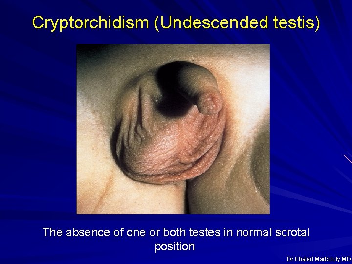 Cryptorchidism (Undescended testis) The absence of one or both testes in normal scrotal position Cryptorchidism (Undescended testis) The absence of one or both testes in normal scrotal position
