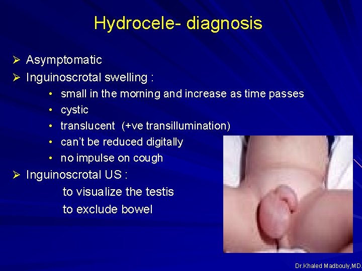 Hydrocele- diagnosis Ø Asymptomatic Ø Inguinoscrotal swelling : • small in the morning and Hydrocele- diagnosis Ø Asymptomatic Ø Inguinoscrotal swelling : • small in the morning and