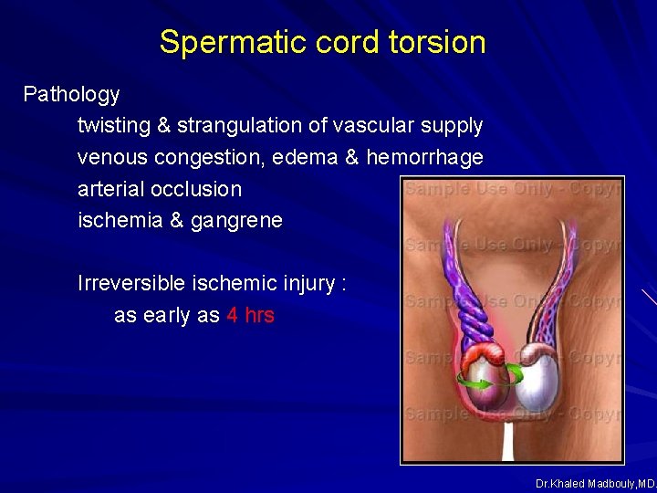 Spermatic cord torsion Pathology twisting & strangulation of vascular supply venous congestion, edema & Spermatic cord torsion Pathology twisting & strangulation of vascular supply venous congestion, edema &