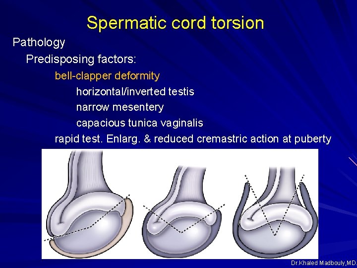 Spermatic cord torsion Pathology Predisposing factors: bell-clapper deformity horizontal/inverted testis narrow mesentery capacious tunica Spermatic cord torsion Pathology Predisposing factors: bell-clapper deformity horizontal/inverted testis narrow mesentery capacious tunica