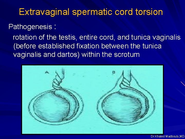 Extravaginal spermatic cord torsion Pathogenesis : rotation of the testis, entire cord, and tunica Extravaginal spermatic cord torsion Pathogenesis : rotation of the testis, entire cord, and tunica
