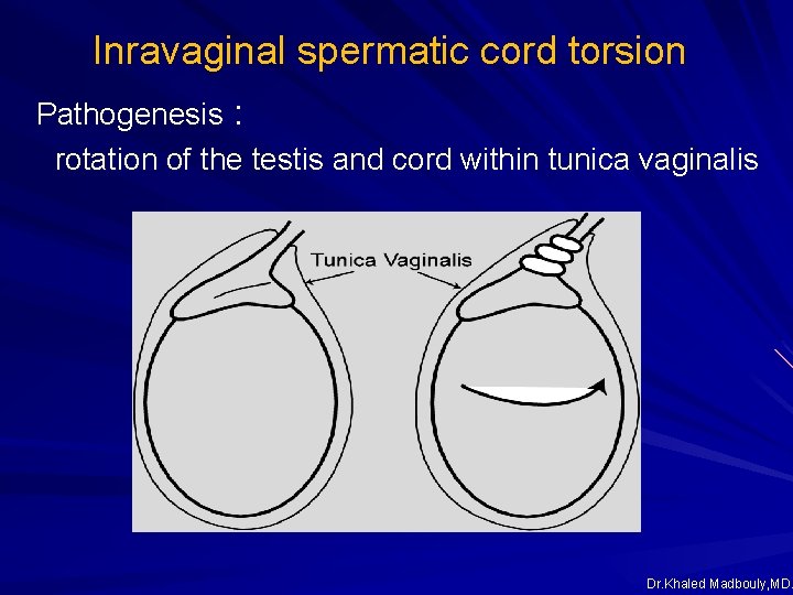 Inravaginal spermatic cord torsion Pathogenesis : rotation of the testis and cord within tunica Inravaginal spermatic cord torsion Pathogenesis : rotation of the testis and cord within tunica