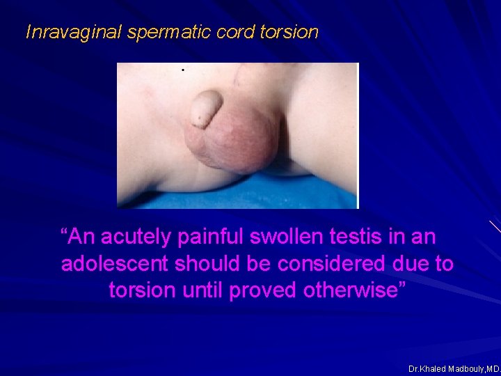 Inravaginal spermatic cord torsion “An acutely painful swollen testis in an adolescent should be Inravaginal spermatic cord torsion “An acutely painful swollen testis in an adolescent should be