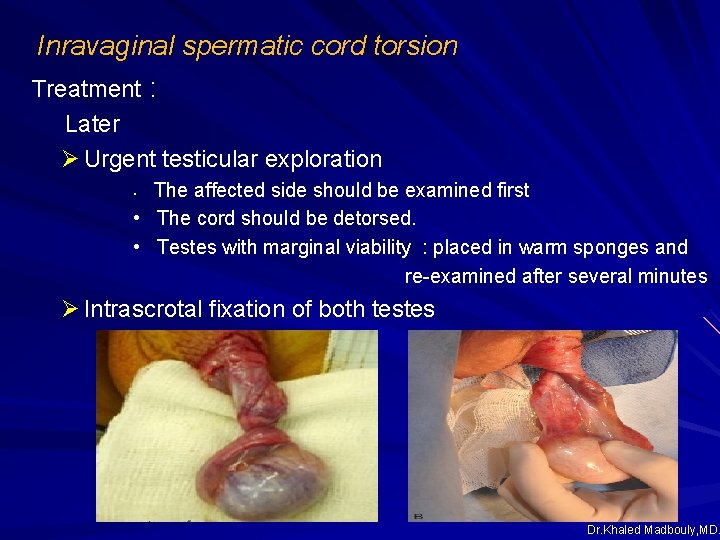 Inravaginal spermatic cord torsion Treatment : Later Ø Urgent testicular exploration The affected side Inravaginal spermatic cord torsion Treatment : Later Ø Urgent testicular exploration The affected side