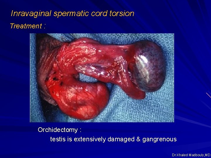 Inravaginal spermatic cord torsion Treatment : Orchidectomy : testis is extensively damaged & gangrenous Inravaginal spermatic cord torsion Treatment : Orchidectomy : testis is extensively damaged & gangrenous