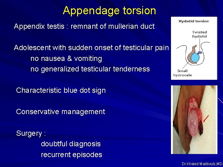 Appendage torsion Appendix testis : remnant of mullerian duct Adolescent with sudden onset of Appendage torsion Appendix testis : remnant of mullerian duct Adolescent with sudden onset of