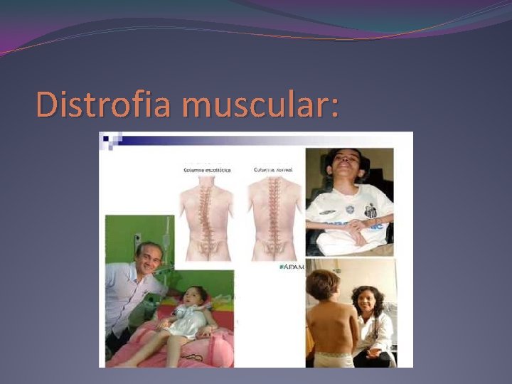 Distrofia muscular: 