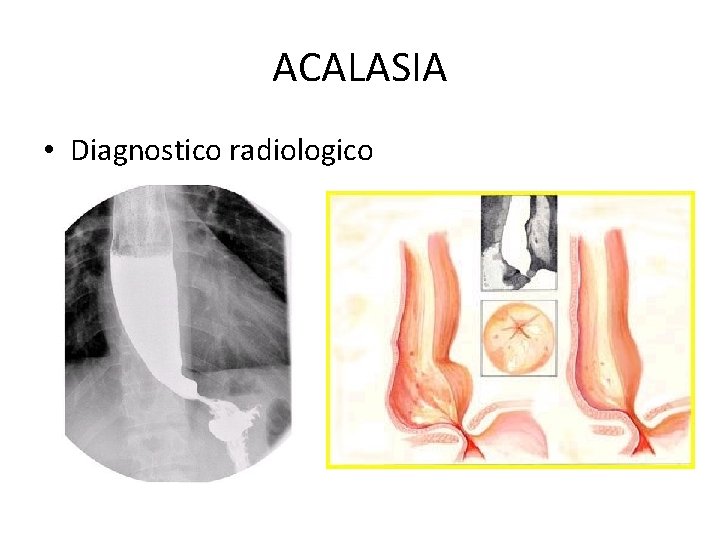 ACALASIA • Diagnostico radiologico 
