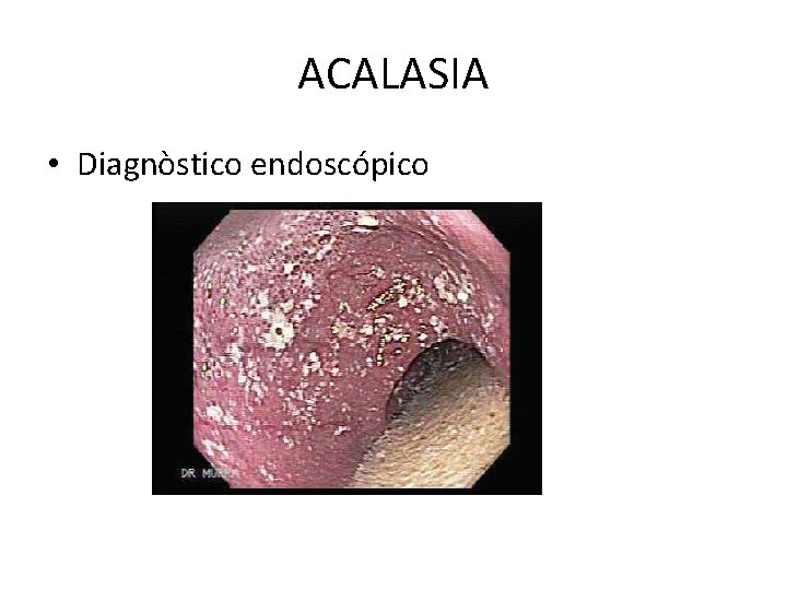 ACALASIA • Diagnòstico endoscópico 