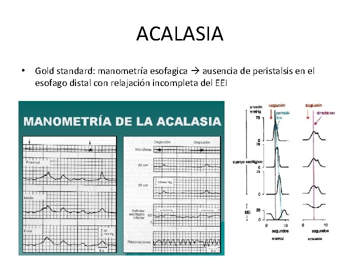 ACALASIA • Gold standard: manometría esofagica ausencia de peristalsis en el esofago distal con