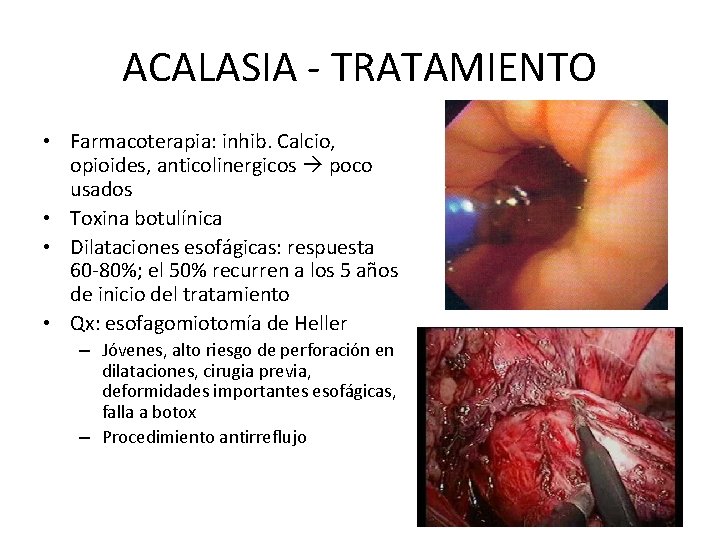 ACALASIA - TRATAMIENTO • Farmacoterapia: inhib. Calcio, opioides, anticolinergicos poco usados • Toxina botulínica