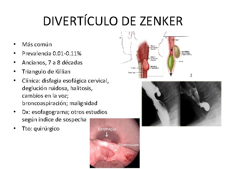 DIVERTÍCULO DE ZENKER Más común Prevalencia 0. 01 -0. 11% Ancianos, 7 a 8