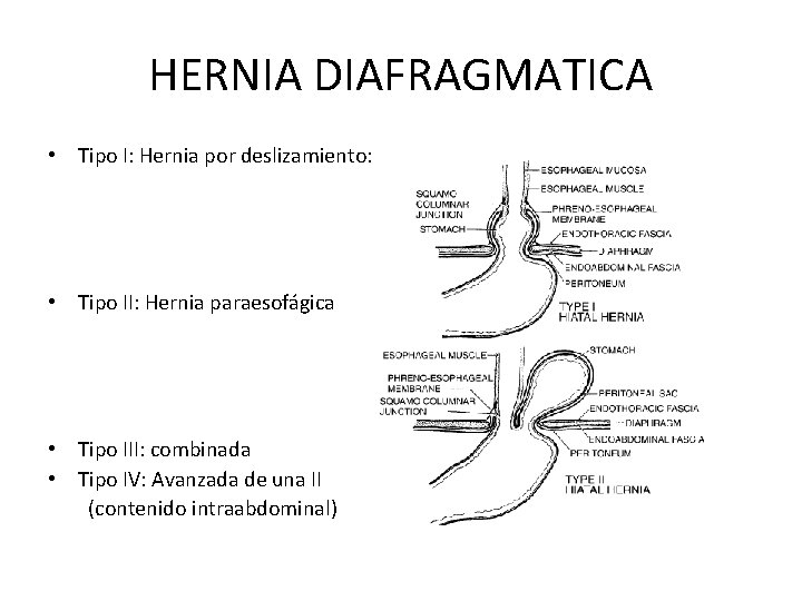 HERNIA DIAFRAGMATICA • Tipo I: Hernia por deslizamiento: • Tipo II: Hernia paraesofágica •