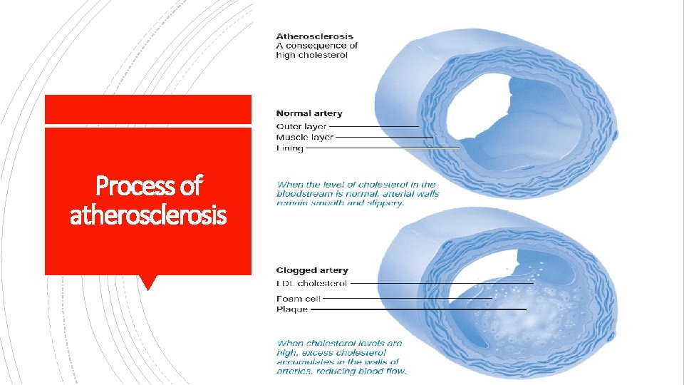 Process of atherosclerosis 