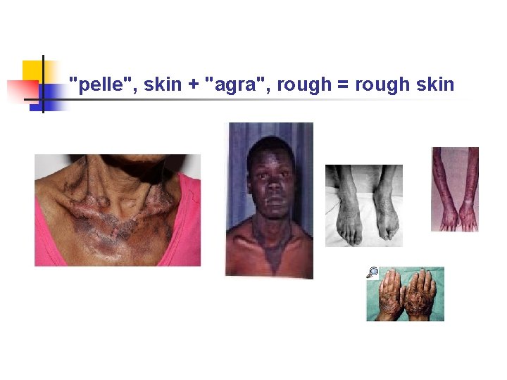 "pelle", skin + "agra", rough = rough skin 