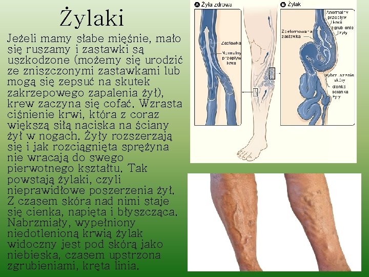 Żylaki Jeżeli mamy słabe mięśnie, mało się ruszamy i zastawki są uszkodzone (możemy się