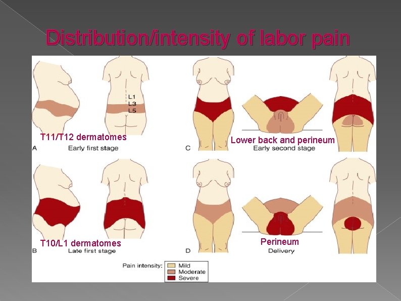 Distribution/intensity of labor pain T 11/T 12 dermatomes T 10/L 1 dermatomes Lower back