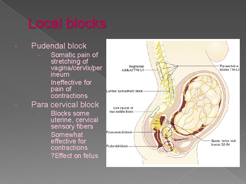 Local blocks • Pudendal block – – • Somatic pain of stretching of vagina/cervix/per