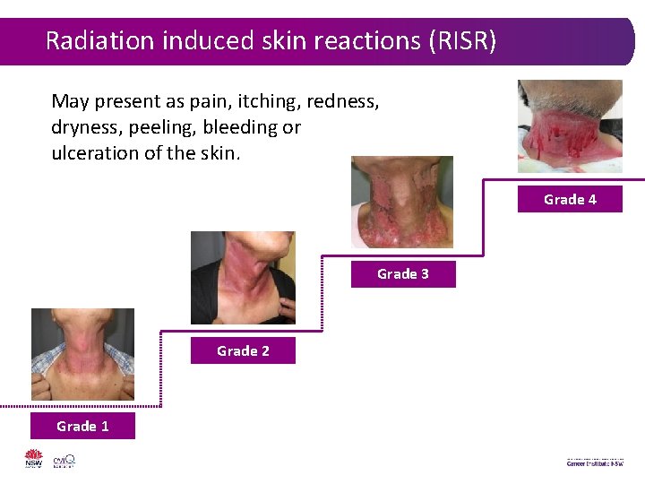 Radiation induced skin reactions (RISR) May present as pain, itching, redness, dryness, peeling, bleeding