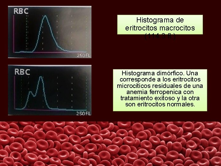 Histograma de eritrocitos macrocitos (114. 3 fl. ) Histograma dimórfico. Una corresponde a los