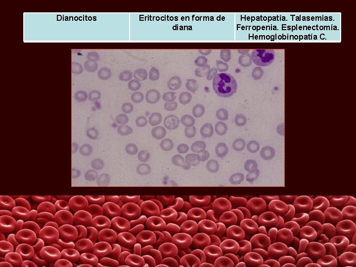 Dianocitos Eritrocitos en forma de diana Hepatopatía. Talasemias. Ferropenia. Esplenectomía. Hemoglobinopatía C. 