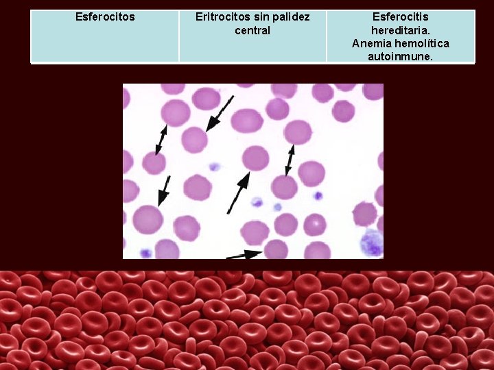 Esferocitos Eritrocitos sin palidez central Esferocitis hereditaria. Anemia hemolítica autoinmune. 