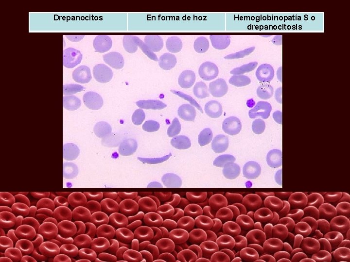 Drepanocitos En forma de hoz Hemoglobinopatía S o drepanocitosis 