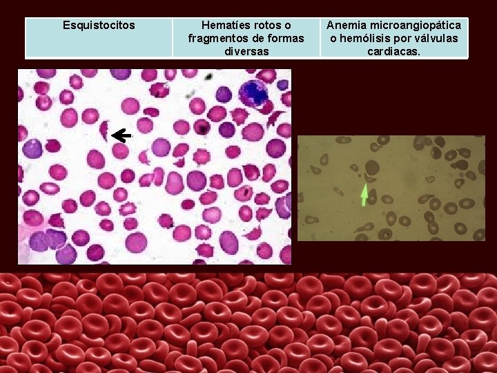 Esquistocitos Hematíes rotos o fragmentos de formas diversas Anemia microangiopática o hemólisis por válvulas