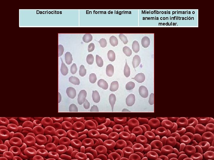 Dacriocitos En forma de lágrima Mielofibrosis primaria o anemia con infiltración medular. 