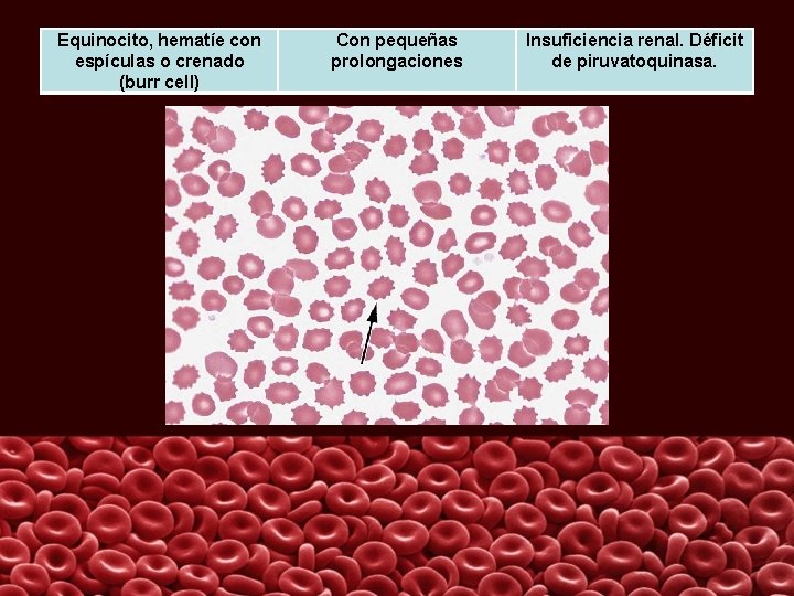 Equinocito, hematíe con espículas o crenado (burr cell) Con pequeñas prolongaciones Insuficiencia renal. Déficit