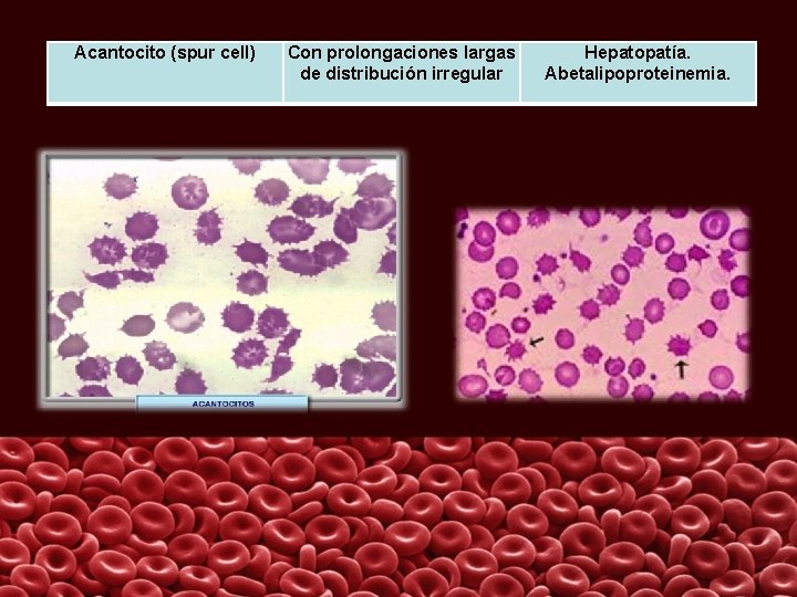 Acantocito (spur cell) Con prolongaciones largas de distribución irregular Hepatopatía. Abetalipoproteinemia. 