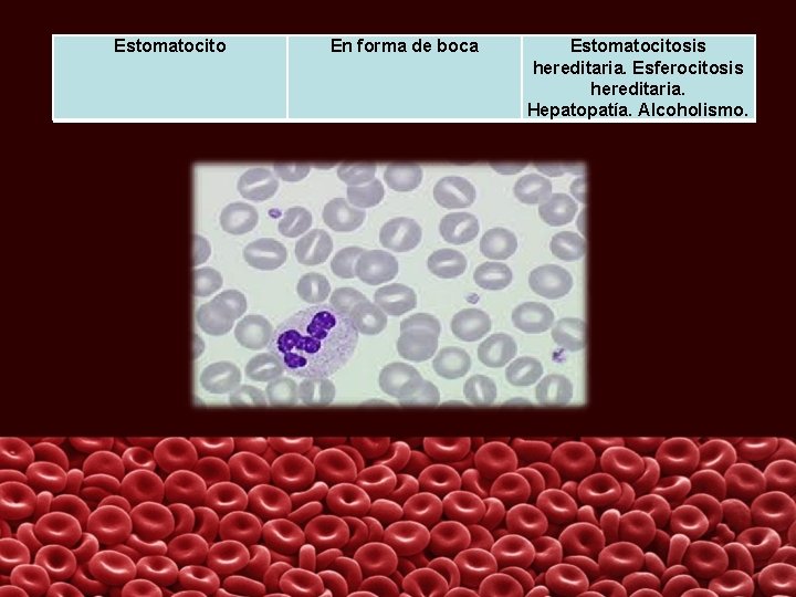 Estomatocito En forma de boca Estomatocitosis hereditaria. Esferocitosis hereditaria. Hepatopatía. Alcoholismo. 